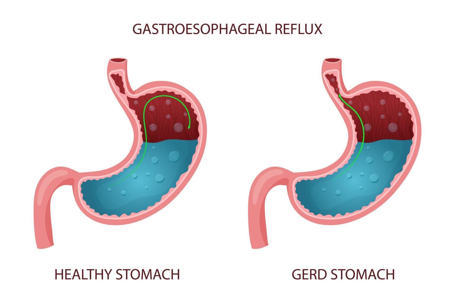 estômago saudável e ilustração da doença do refluxo gastroesofágico vetor