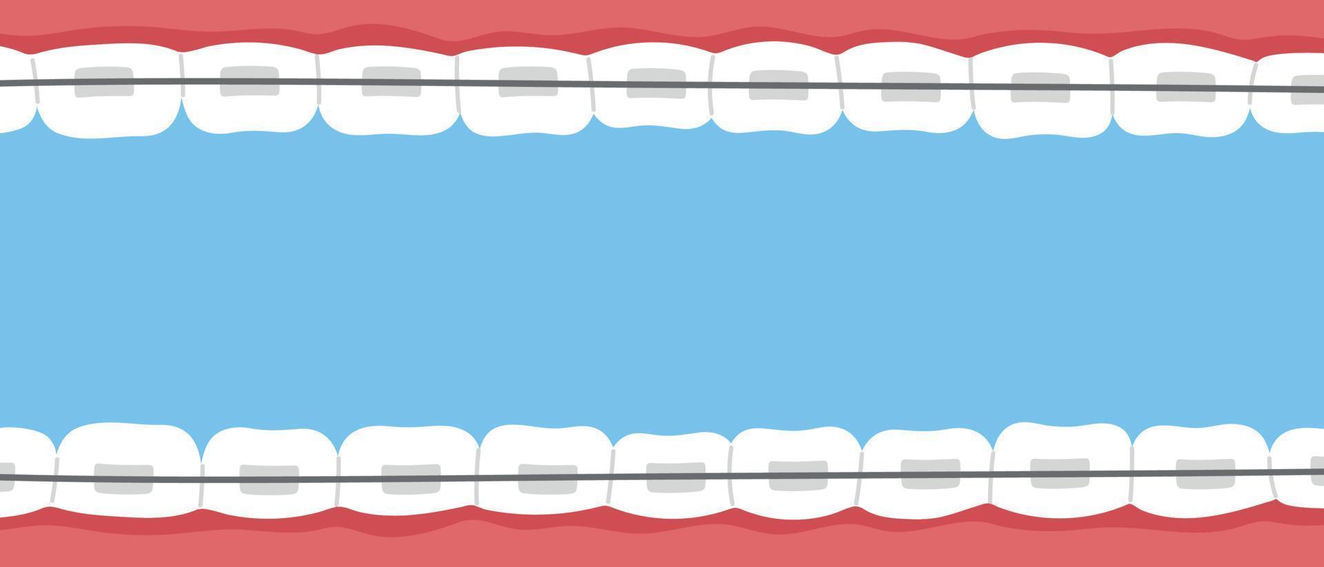 bandeira de aparelho dentário. problema ortodôntico, sorriso com braquetes, retentor. ilustração isolada de vetor plano