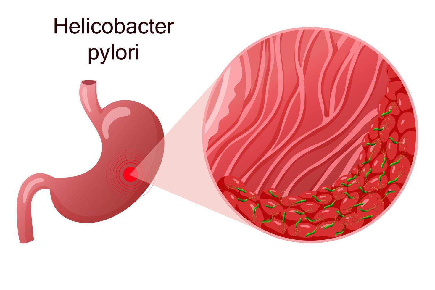 Helicobacter pylori no estômago sob ampliação. ilustração vetorial detalhada, estilo cartoon vetor