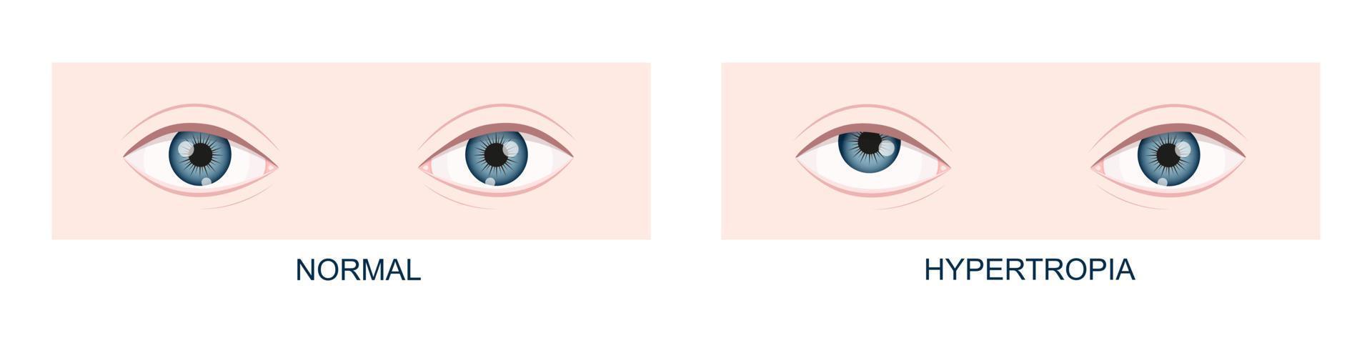 hipertropia. estrabismo vertical antes e depois da cirurgia. olhos humanos saudáveis e com olhar para cima. visão dupla vetor
