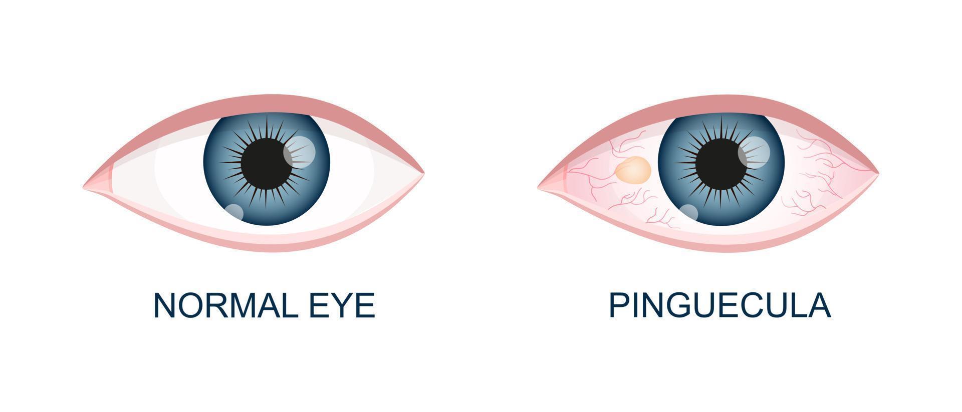 olho saudável e com pinguécula. degeneração conjuntival antes e depois da cirurgia. doença ocular. órgão humano da visão com patologia vetor