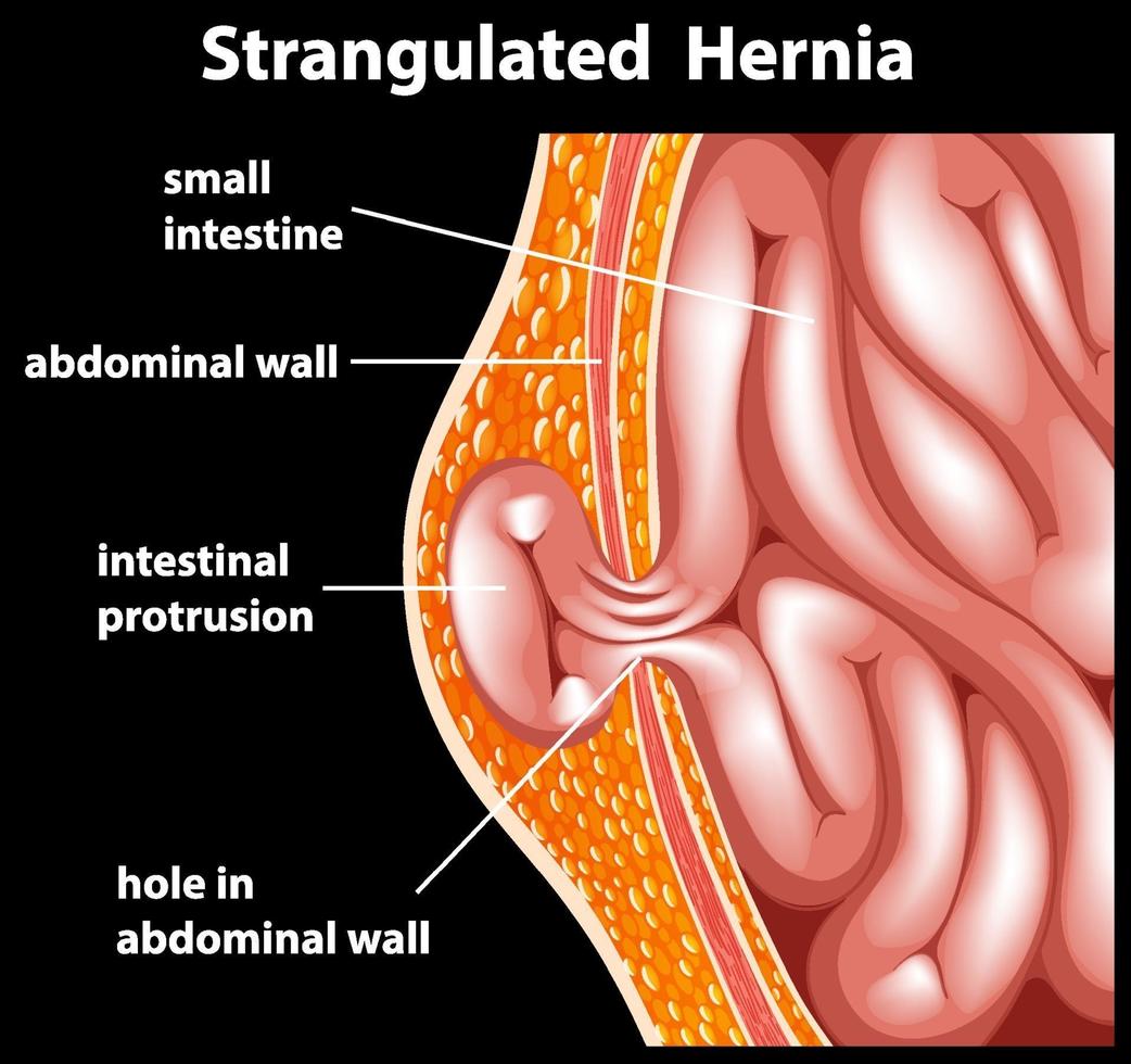 diagrama de anatomia de hérnia estrangulada vetor