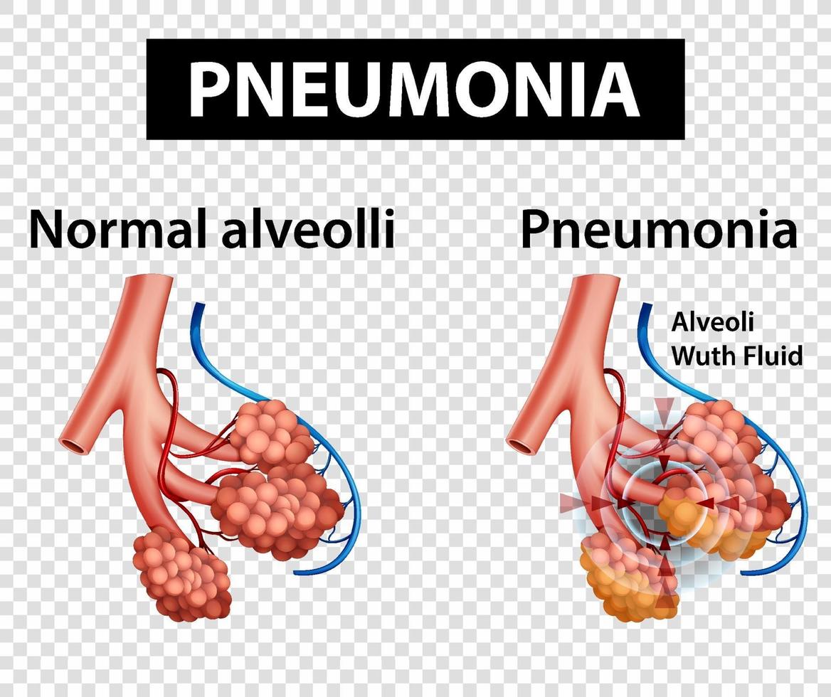 diagrama mostrando pneumonia em fundo transparente vetor