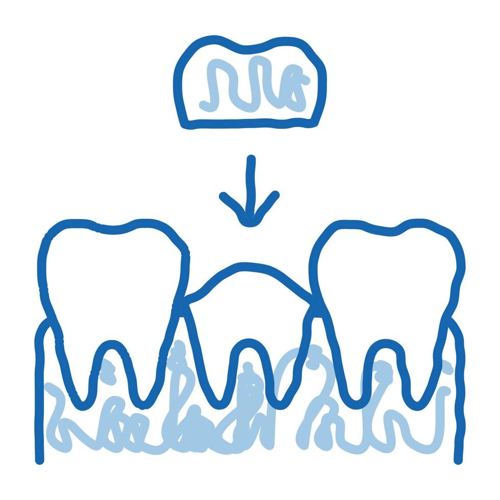 estomatologia coroa do dente doodle ícone ilustração desenhada à mão vetor