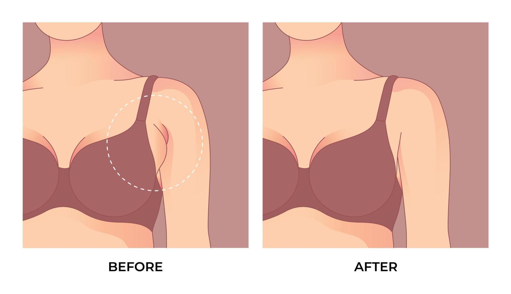 gordura da axila antes e depois da braquioplastia, lipoaspiração ou cirurgia plástica, transformação da forma do corpo da mulher, gordura para caber. vetor