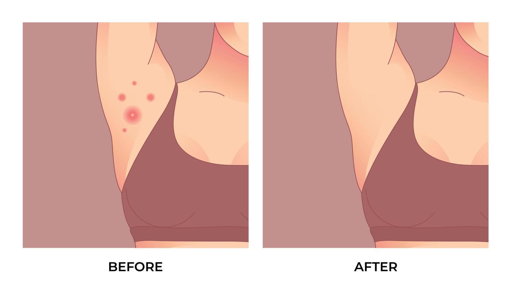 foliculite inflamatória, acne inversa, hidradenite supurativa na axila. tratamento de acne antes e depois. conceito de cuidados com a pele. vetor