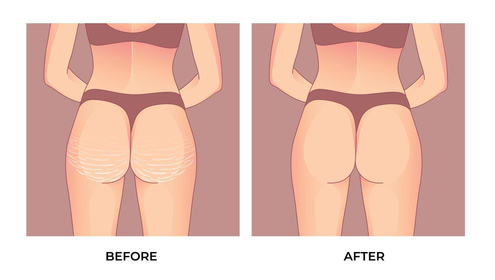 nádegas femininas com estrias antes e depois da braquioplastia, lipoaspiração ou cirurgia plástica, transformação da forma do corpo da mulher, gordura para caber. vetor