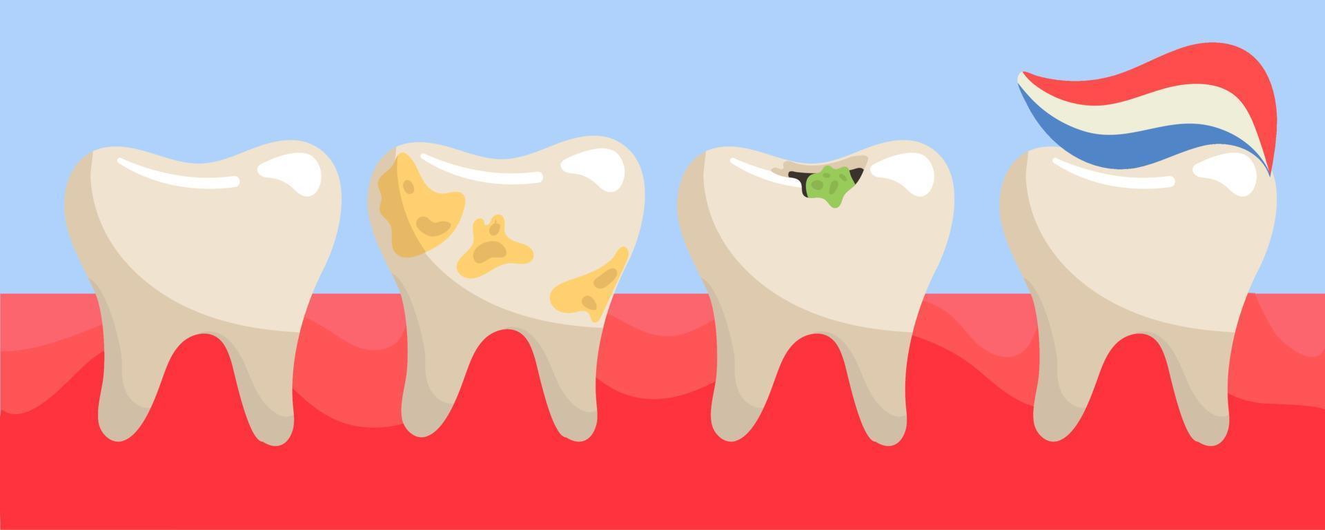 uma conjunto do dentes em a gengivas é uma saudável dente, placa em a dentes, uma dente com cárie, uma dente com listrado pasta de dentes. a dentes estão diferente em a gengivas. ilustração dentro uma plano estilo vetor