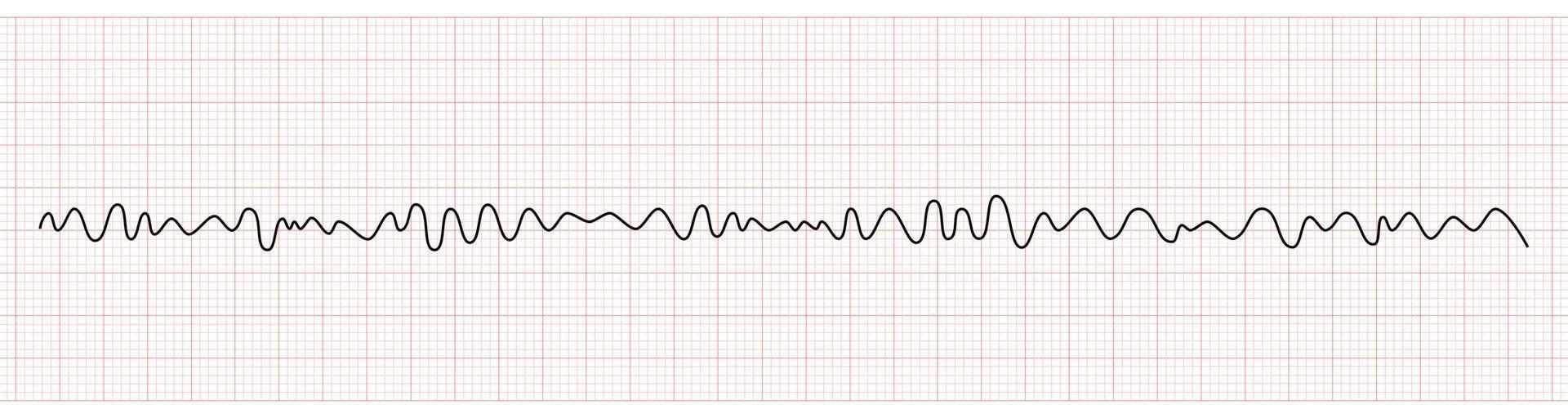 ekg monitor mostrando ventricular fibrilação ou vf vetor