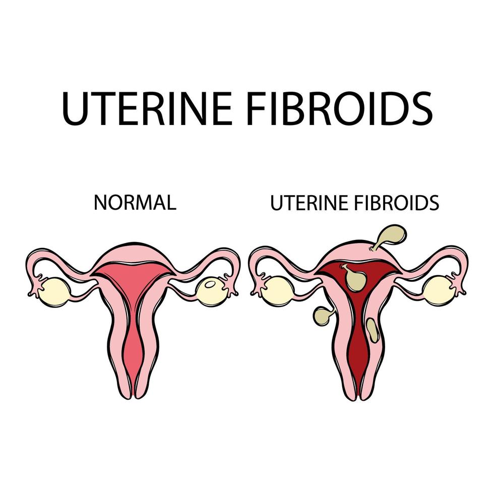 uterino miomas vs normal fêmea reprodutivo Educação conjunto vetor