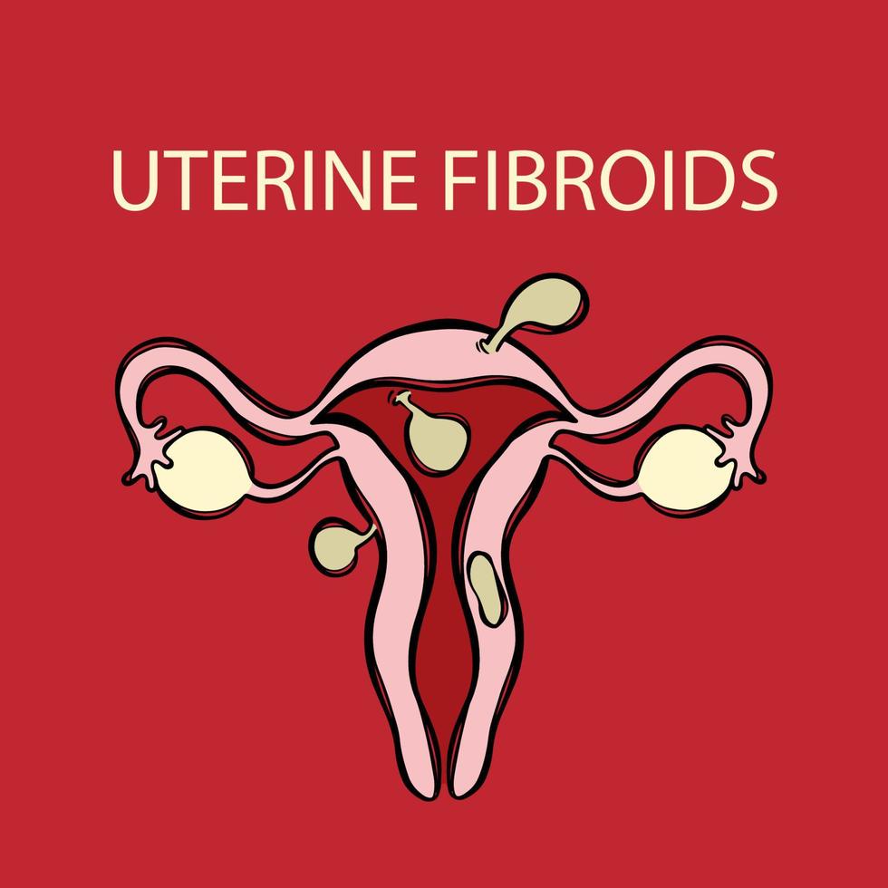 uterino miomas fêmea reprodutivo remédio Educação vetor