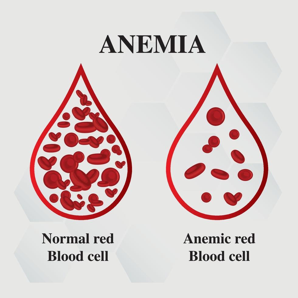 anemia quantidade de sangue vermelho deficiência de ferro anemia diferença de anemia quantidade de glóbulos vermelhos e sintomas normais ilustração vetorial médica. vetor