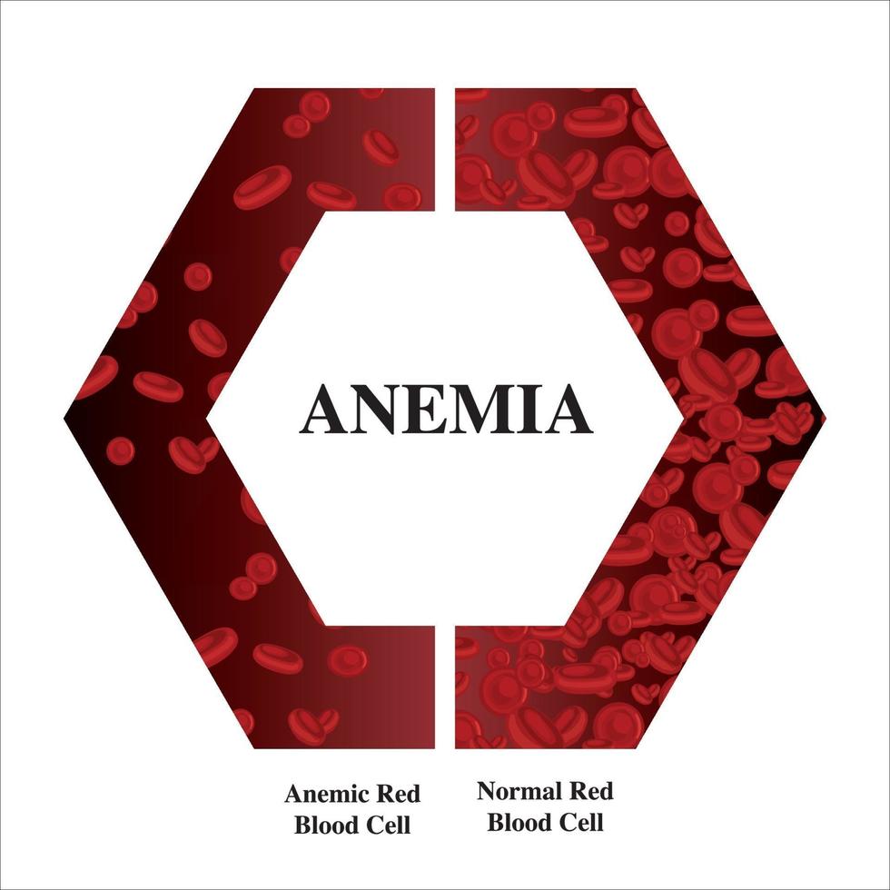 anemia quantidade de sangue vermelho deficiência de ferro anemia diferença de anemia quantidade de glóbulos vermelhos e sintomas normais ilustração vetorial médica. vetor