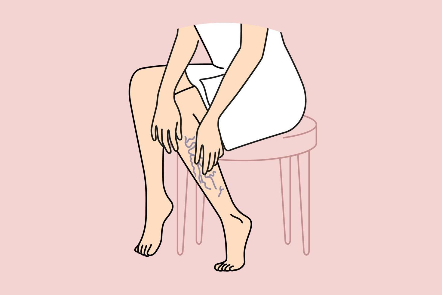 mulher tocante pernas com varicoso veias. fêmea com vascular perna doença Sofra a partir de ampliado sangue embarcações. vetor ilustração.