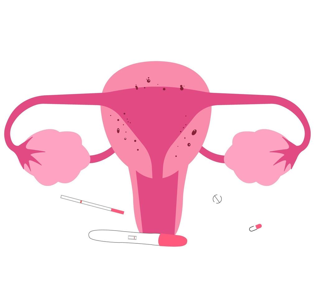 adenomiose, uma das condições médicas do órgão reprodutor feminino. causa infertilidade. vetor