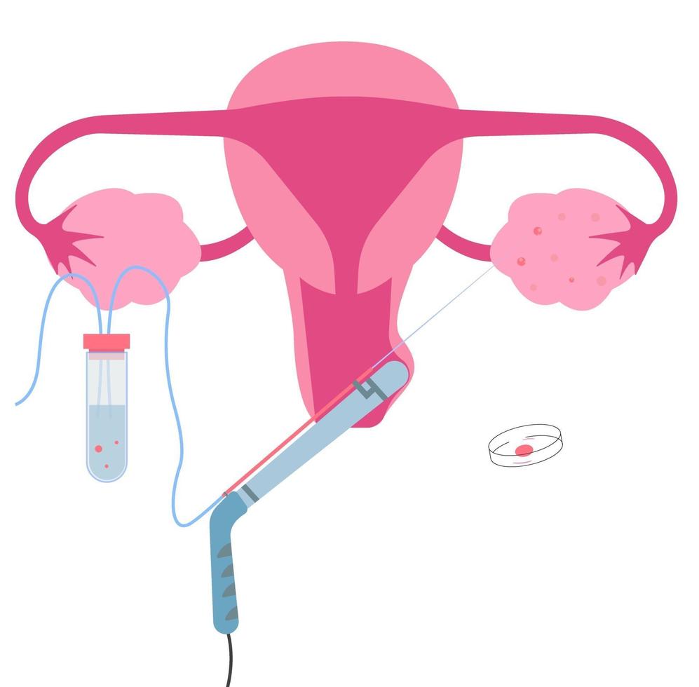 recuperação transvaginal de oócitos, uma de fertilização in vitro ou procedimento ivf. vetor