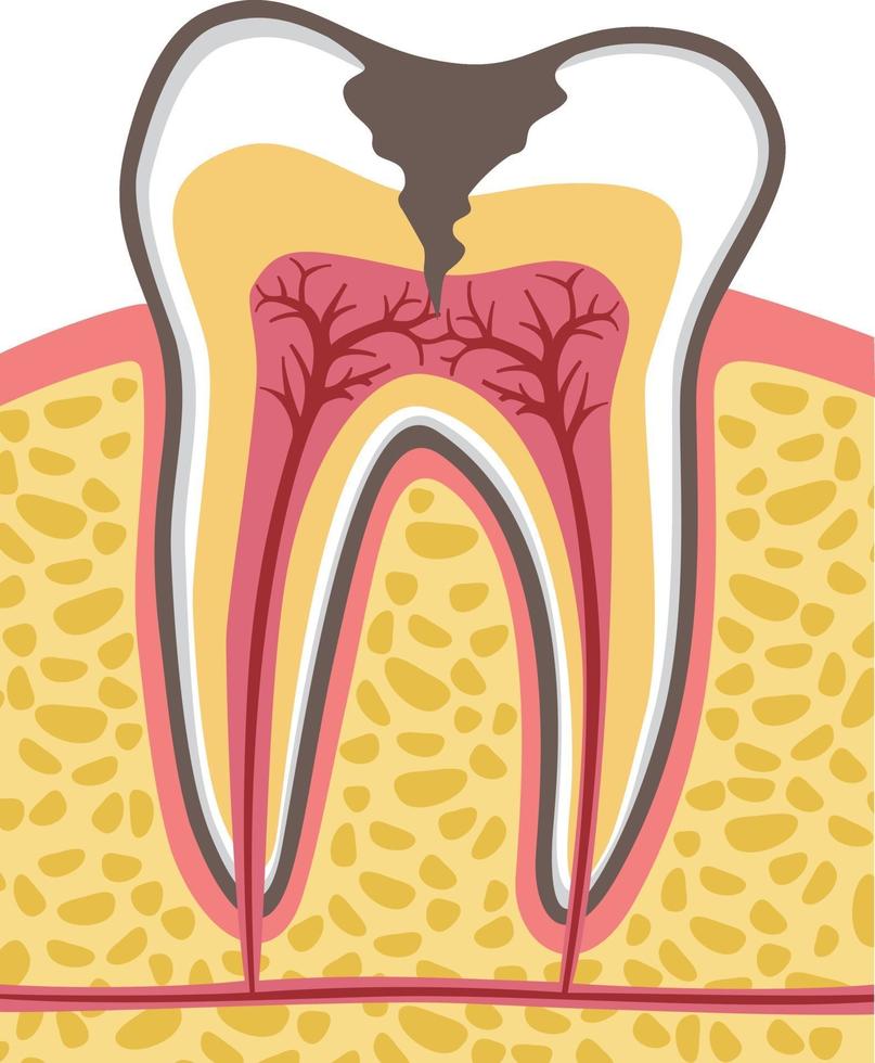 seção transversal do dente com cárie dentária vetor