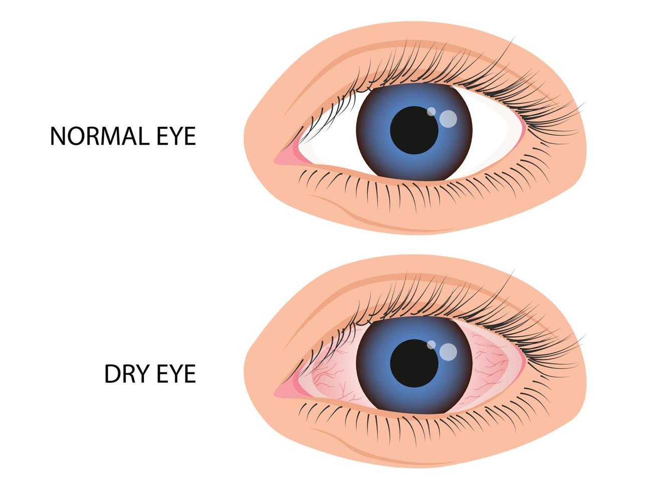 humano olho saudável e seco. sintomas do ceratite, alergia, conjuntivite, uveíte vetor