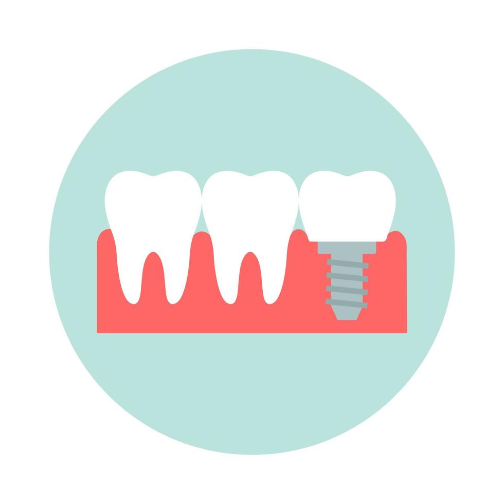 saudável dentes com dental implantes. plano Projeto vetor ilustração.