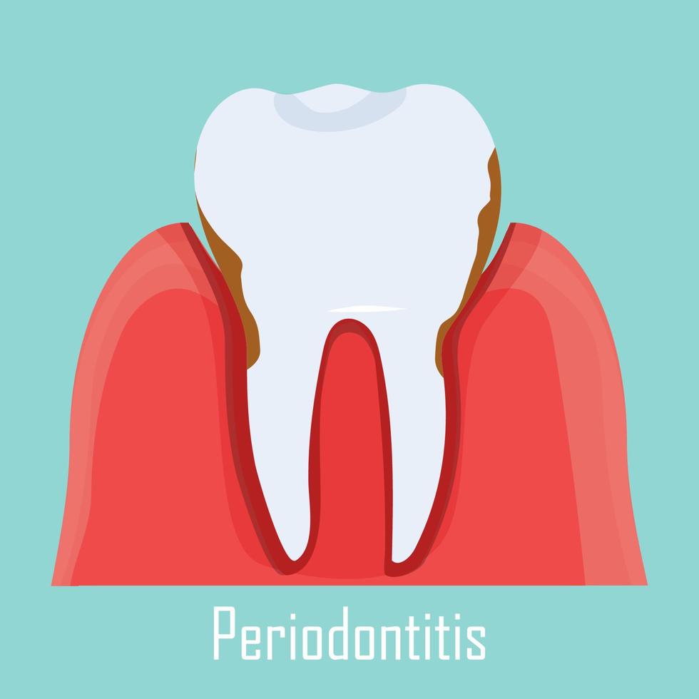 periodontite problema, Chiclete doente. ilustração do humano dente com dental inflamação isolado. . vetor ilustração