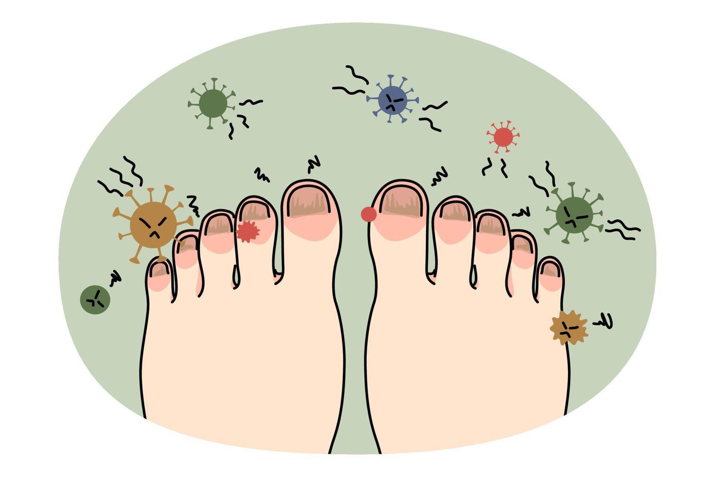 pouco saudável pé com unha infecção ou vírus vetor