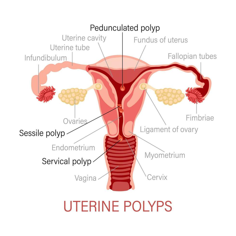 tipos do uterino pólipos. doenças do a fêmea reprodutivo sistema. ginecologia. médico conceito. infográfico bandeira. vetor
