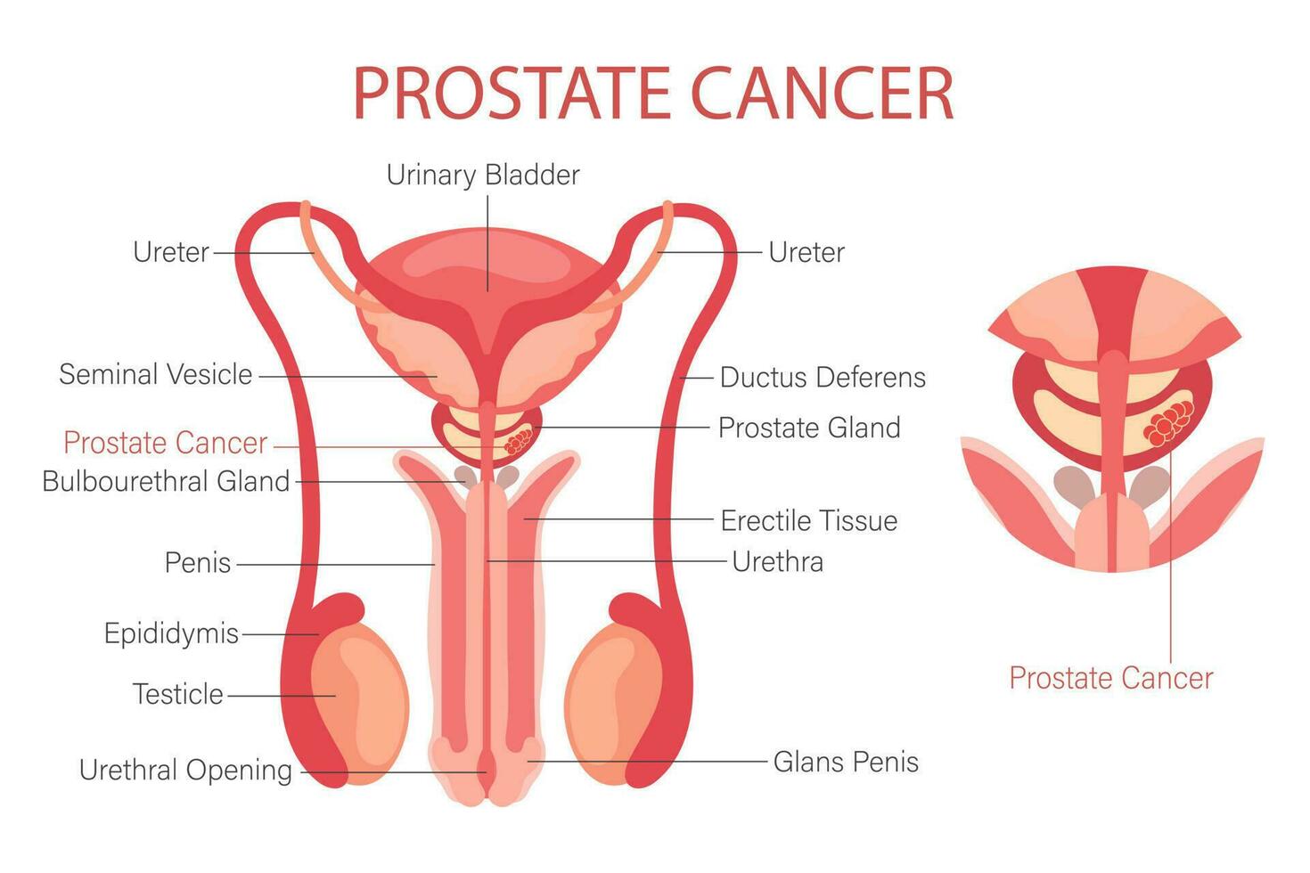 próstata Câncer. masculino reprodutivo sistema. anatomia do a interno órgãos do cara. infográfico bandeira, diagrama, vetor