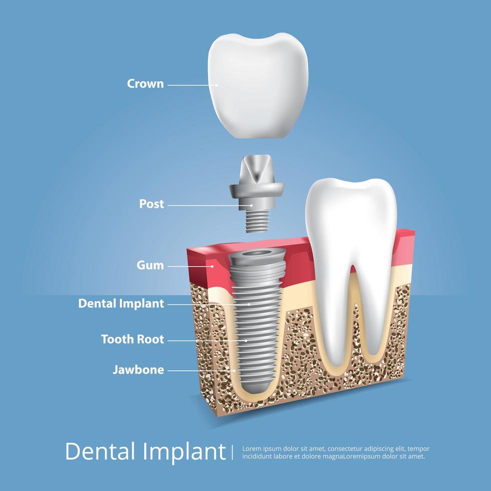 ilustração em vetor dentes humanos e implante dentário