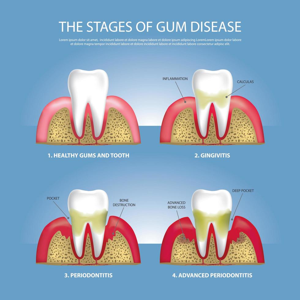 ilustração vetorial de estágios de dentes humanos de doença gengival vetor