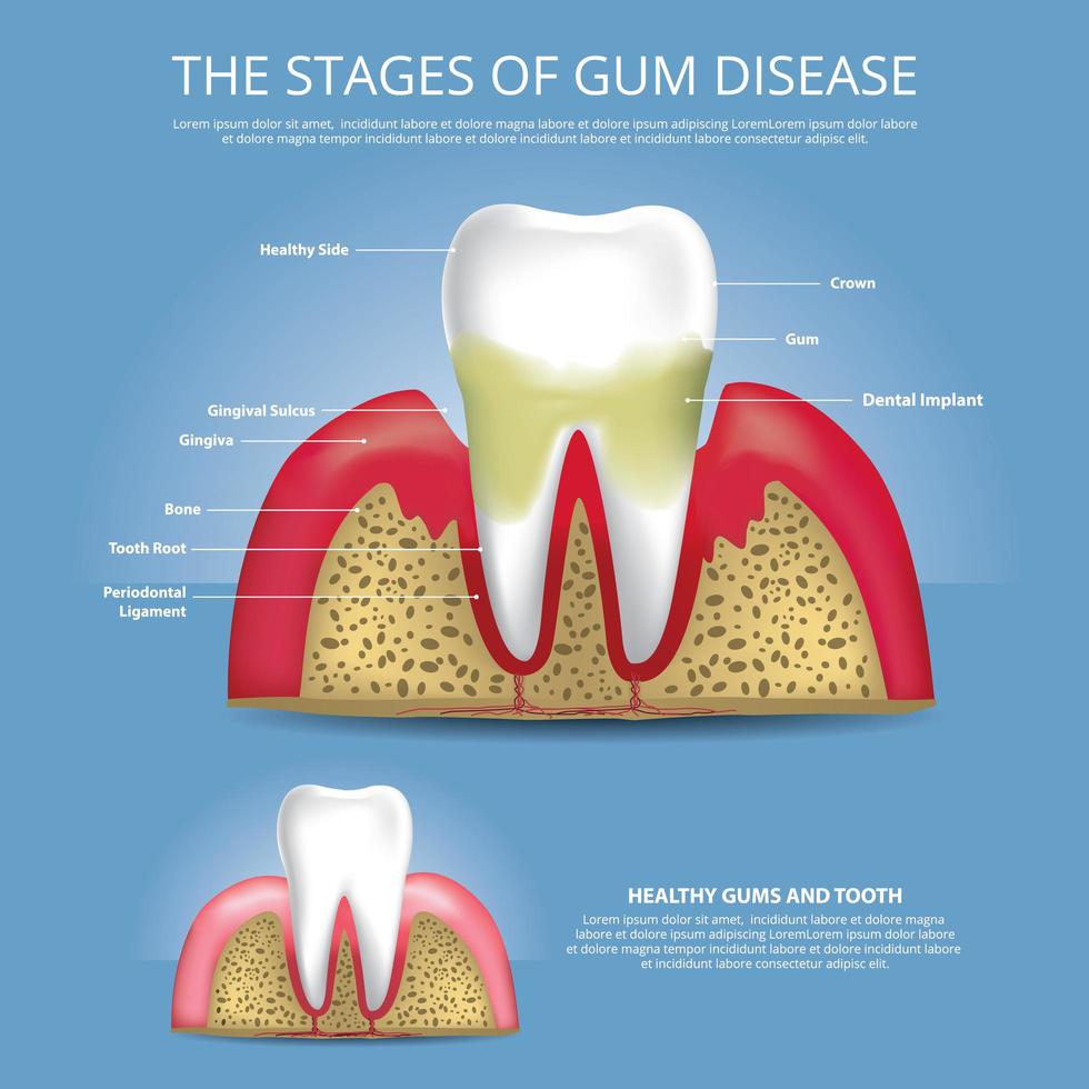 ilustração vetorial de estágios de dentes humanos de doença gengival vetor