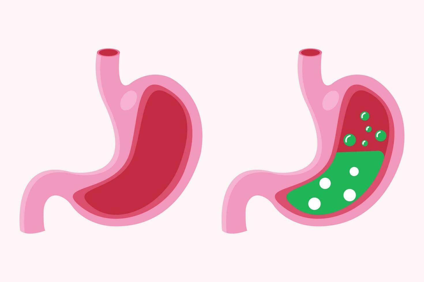 ilustração do pirose estômago e náusea estômago. pirose fogo transtorno, gástrico ácido refluxo. estômago médico ilustração conjunto vetor