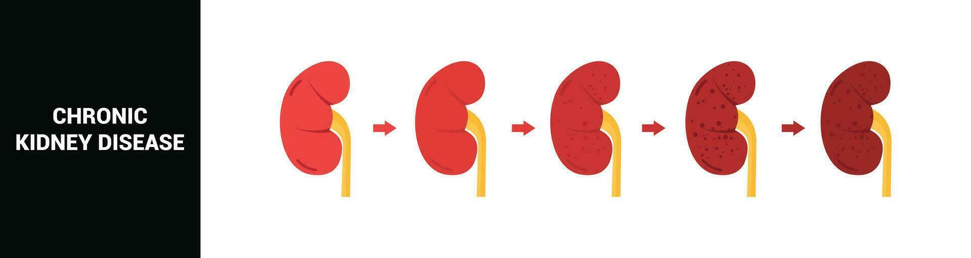 crônica rim doença vetor ilustração
