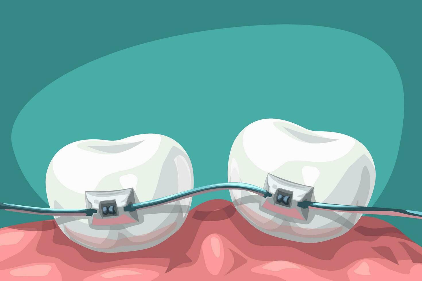 desenho animado dentes com aço suspensórios vetor