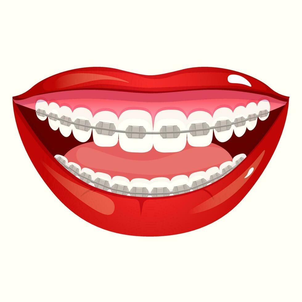 menina vermelho lábios sorrir com dentes com ortodôntico suspensórios vetor