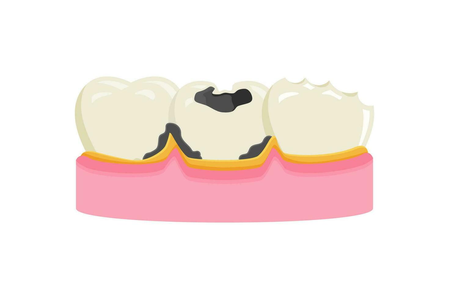 cavidade dentes vetor ilustração. dor de dente ícone placa símbolo