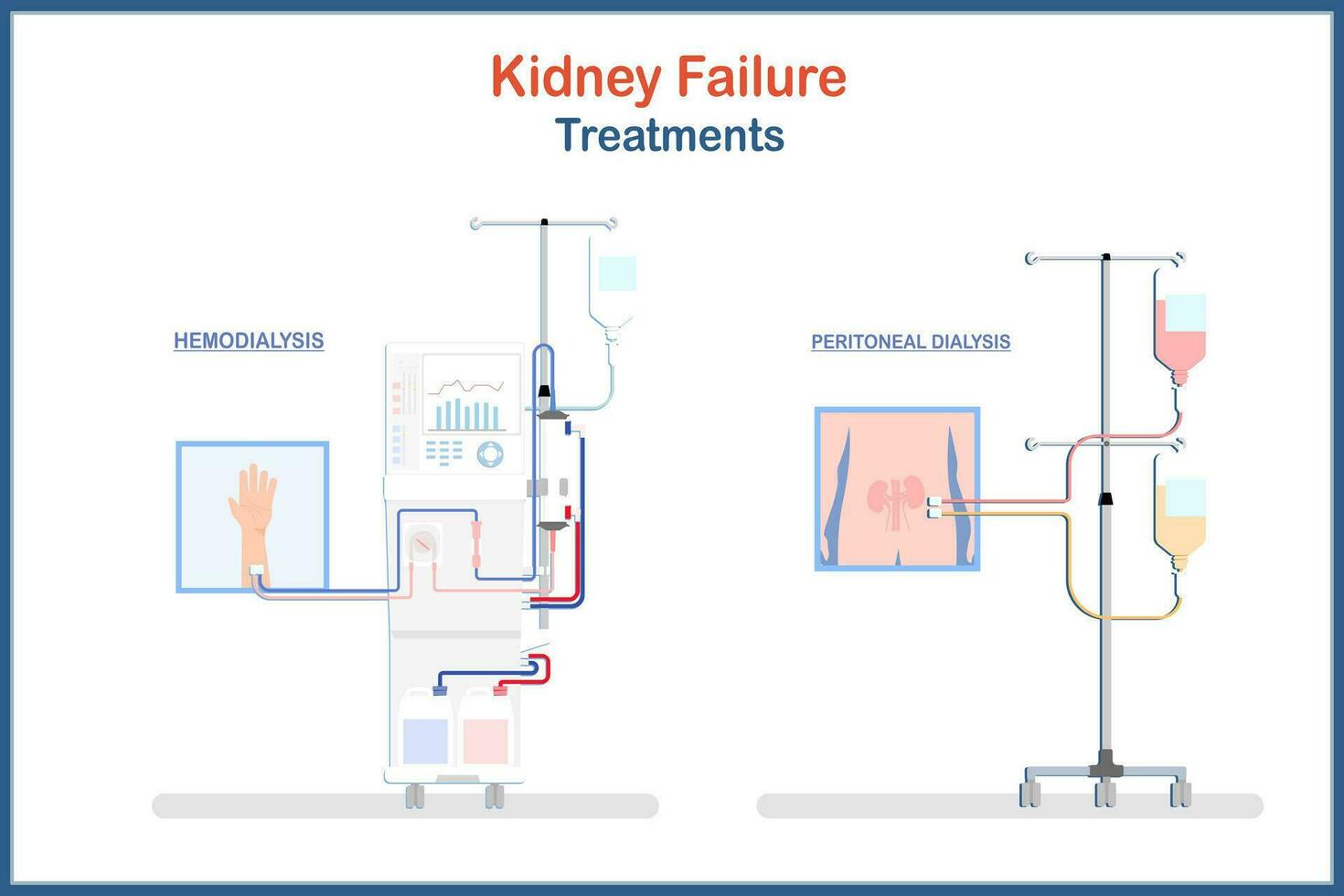 médico ilustração tratamento do rim falha. hemodiálise e peritoneal diálise.vetor ilustrações plano estilo.saúde Cuidado e médico conceitos. vetor