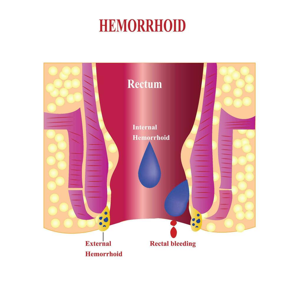 interno hemorróidas e externo hemorróidas. hemorróidas e inflamação causa sangrando através a fístula do a paciente.cruz seção do a reto e anal canal vetor