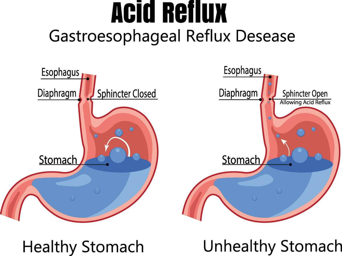a humano estômago é cheio do estômago ácido. ácido refluxo ou gastroesofágico refluxo, azia. estômago doença, estômago problema doença conceito. vetor desenhando