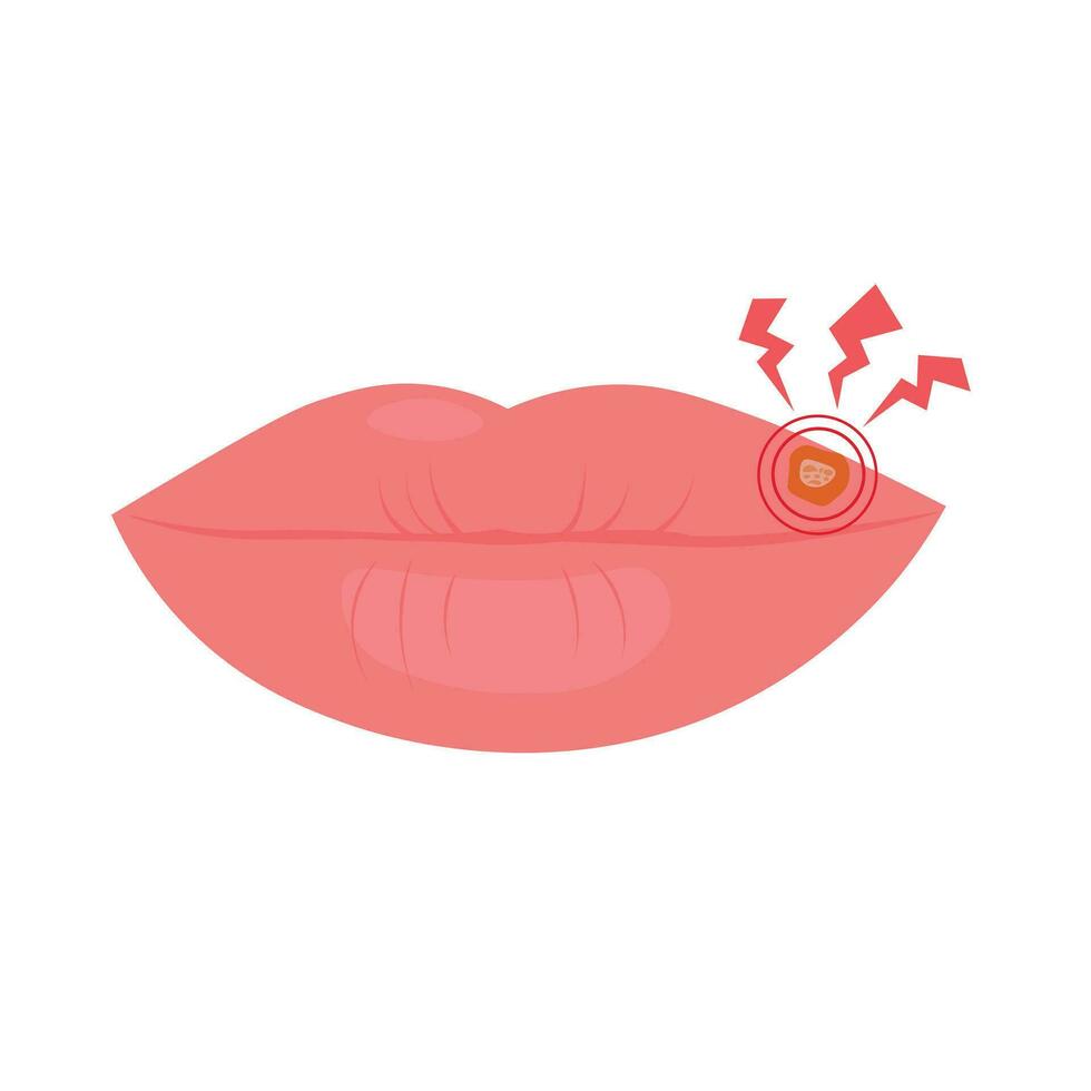 lábios afetado de herpes. vetor ilustração. isolado em uma branco fundo. uma ferida em uma mulher lábios. embalagem do a vírus remédio.