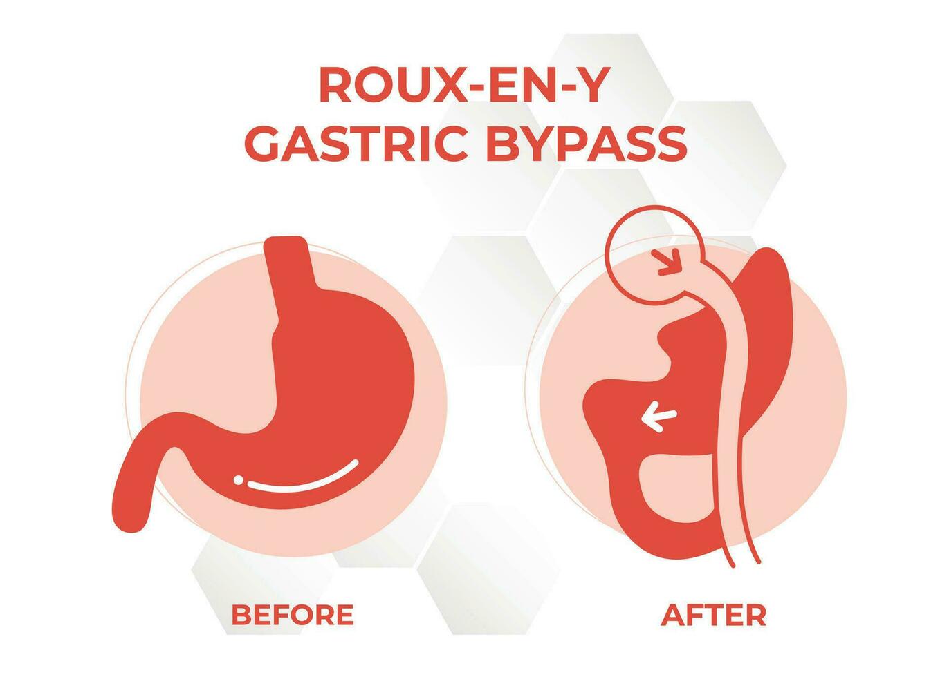 gástrico desviar rny peso perda cirurgia vetor ilustração ícone roux-en-y