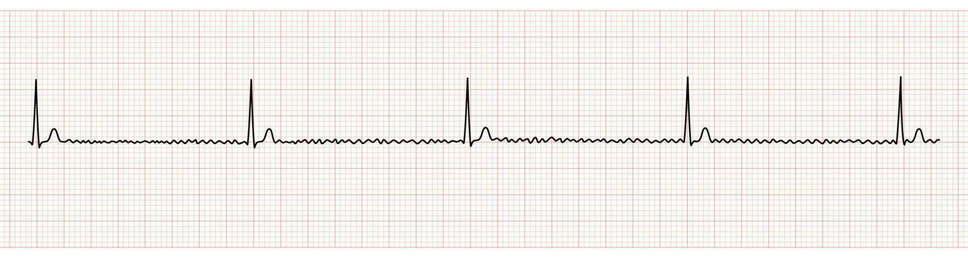 ekg monitor mostrando regularizado atrial fibrilação ou af com quadra vetor