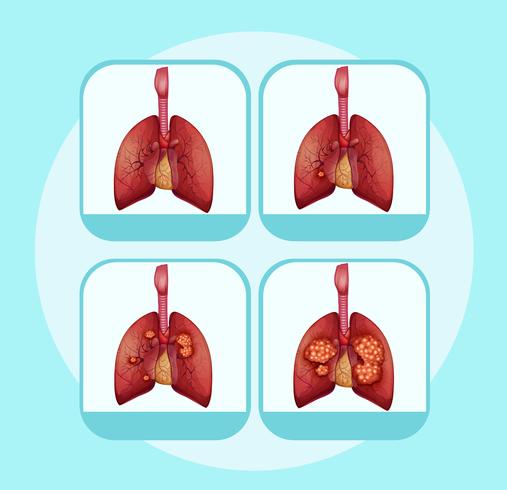 Diagrama mostrando diferentes estágios do câncer de pulmão vetor