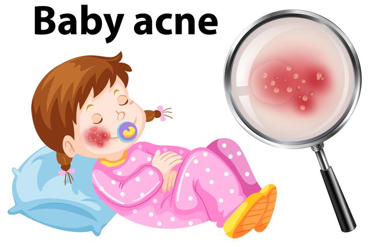 Um bebê acne no rosto vetor