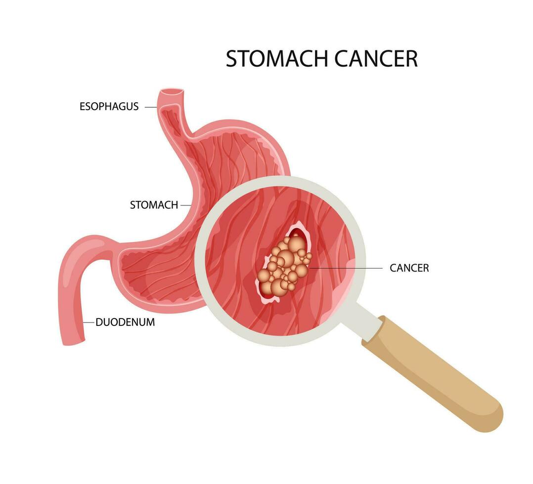 estômago Câncer. maligno canceroso tumor ampliado debaixo ampliação vidro. anatômico vetor ilustração isolado branco fundo desenho animado estilo