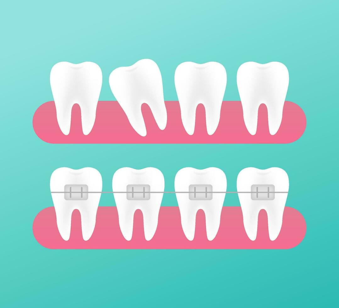 correção do dentes com ortodôntico aparelho ortodôntico. estágios do dentes alinhamento. dental clínica Serviços. vetor ilustração