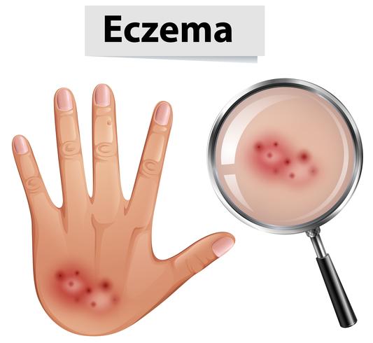 Uma mão humana com eczema vetor