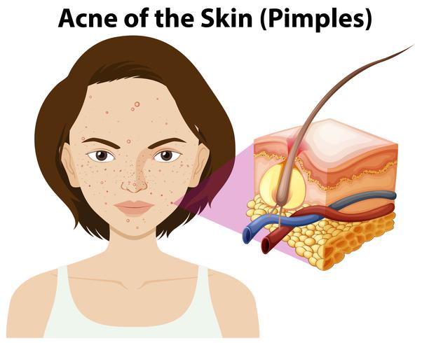 Acne da pele em uma mulher vetor