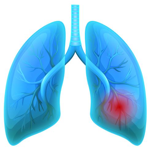 Doença pulmonar no fundo branco vetor