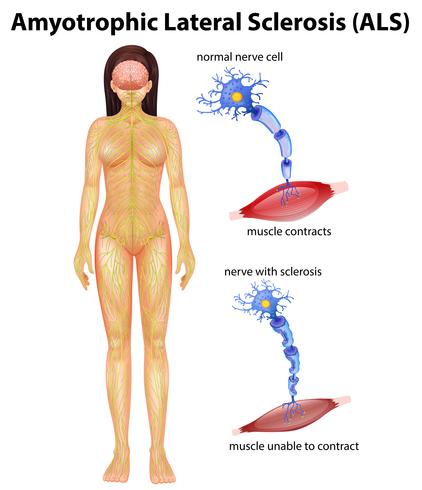 Esclerose lateral amiotrófica feminina vetor