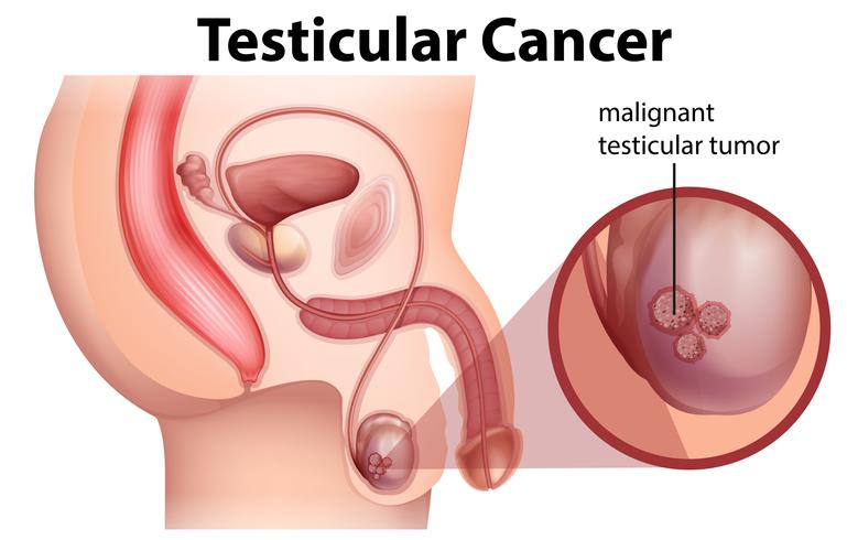 Uma anatomia masculina do câncer testicular vetor